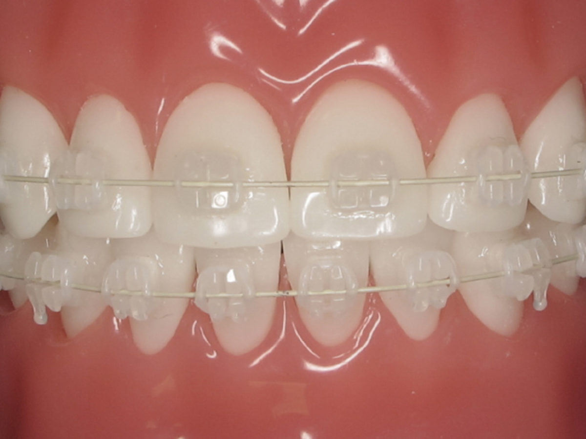 Ceramic Braces Different From Metal 1200x900 1