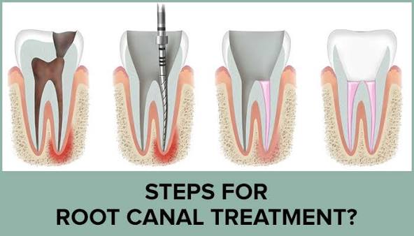Rootcanal