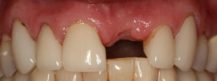 1 Before Dental Implants 1 Before Dental Implants