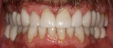 After Dental Implants2 1