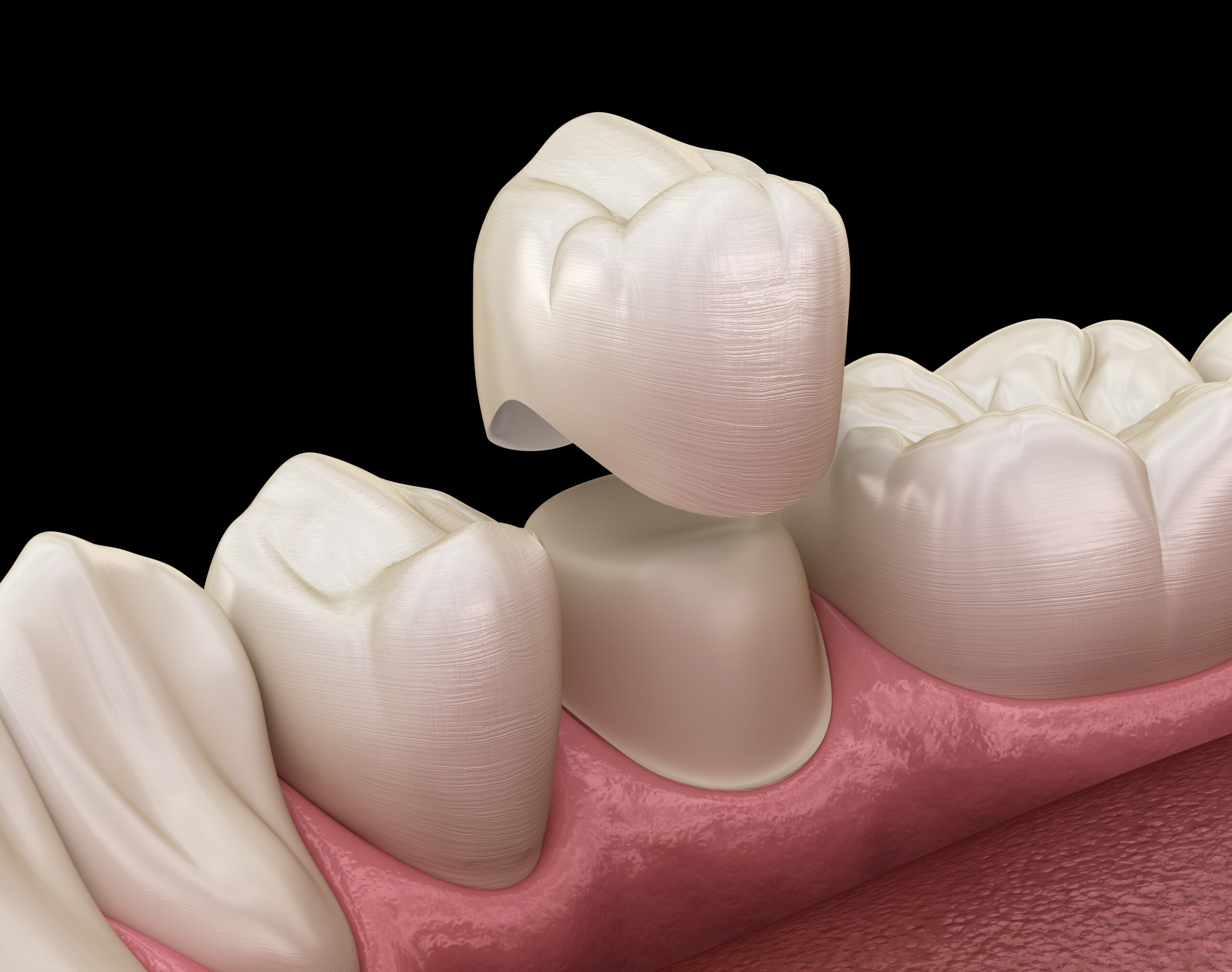 What Is The Purpose Of A Tooth Crown Scaled 1